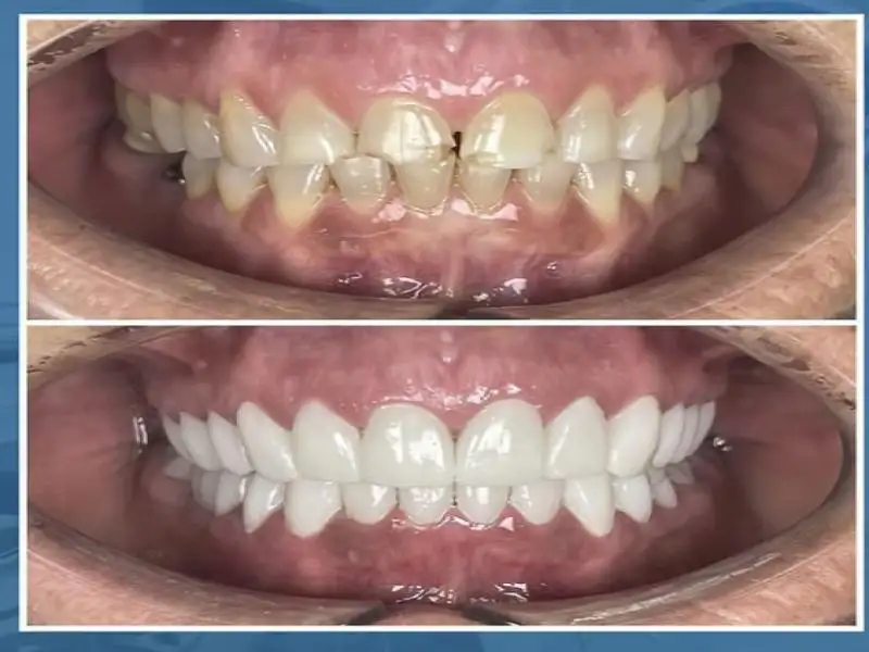 Before and after 