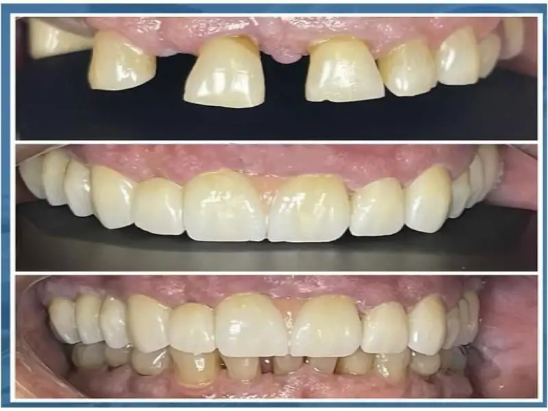 Before and after 
