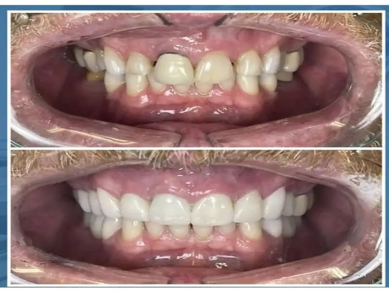 Before and after 