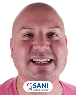 After: Porcelain Veneers & Whitening at Sani Dental Group
