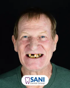 Before: All-on-4 Implants at Sani Dental Group
