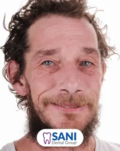 After: All-on-4 Implants at Sani Dental Group