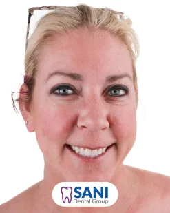 Before: Veneers & Teeth Whitening at Sani Dental Group