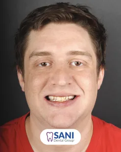 Before: Implant, Crown & Bone Graft at Sani Dental Group