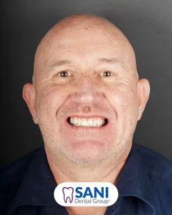 After: Zirconia Crown & Implants at Sani Dental Group