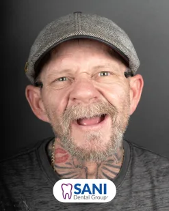 After: Single & Multiple Tooth Implants at Sani Dental Group