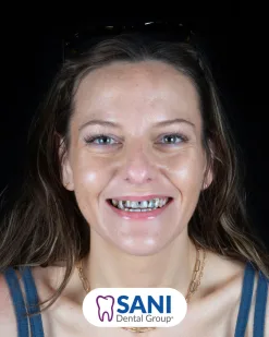 After: Single & Multiple Tooth Implants at Sani Dental Group