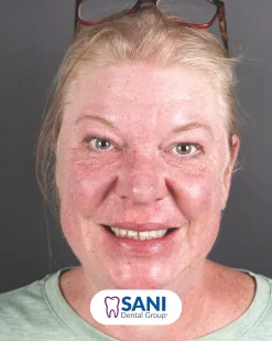 After: Zirconia Crown & Root Canal at Sani Dental Group