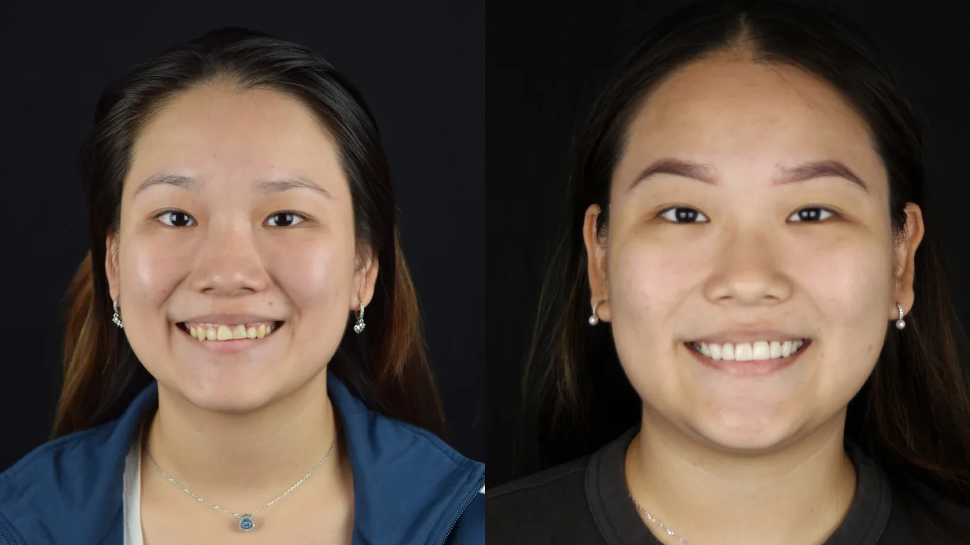 Porcelain veneers before and after - Panama City