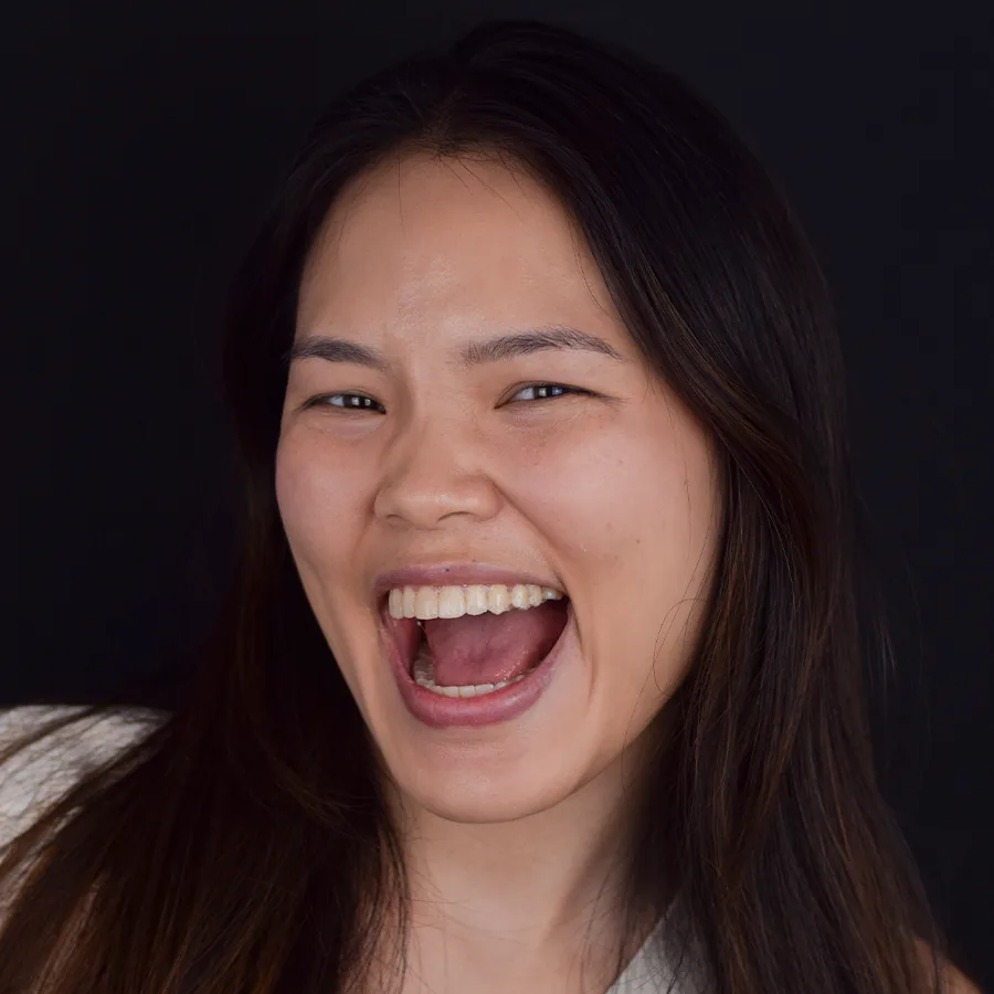 Smile makeover with dental veneers