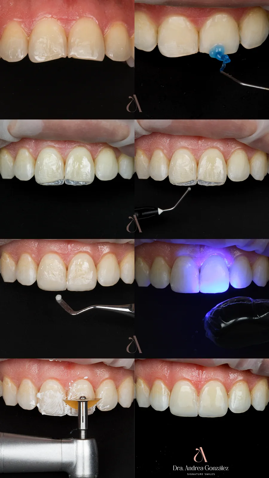 Incisal edge restoration step by step