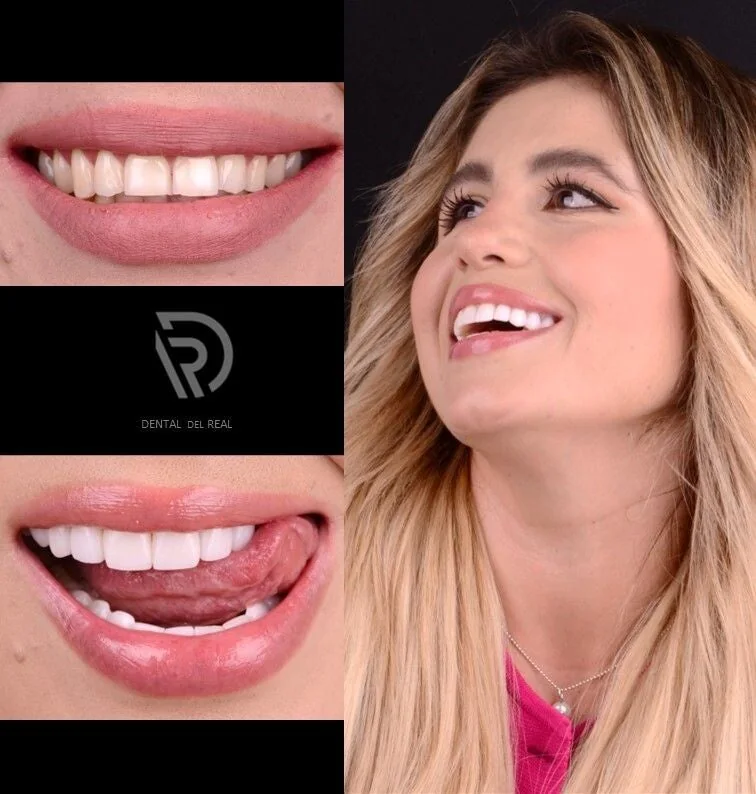 Smile makeover before and after - Dental del Real Guadalajara