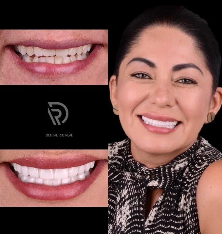 Porcelain veneers before and after - Dental del Real