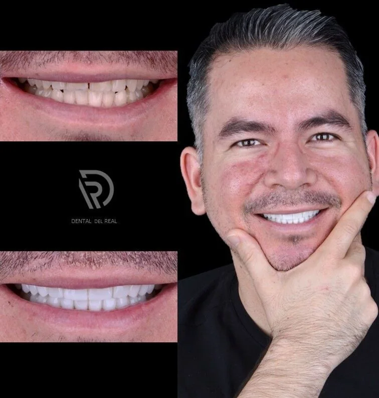 Smile design result - Dental del Real Zapopan
