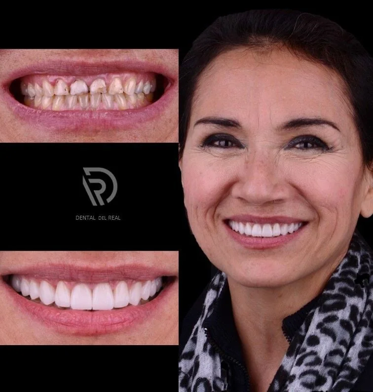 Veneers smile transformation - Guadalajara