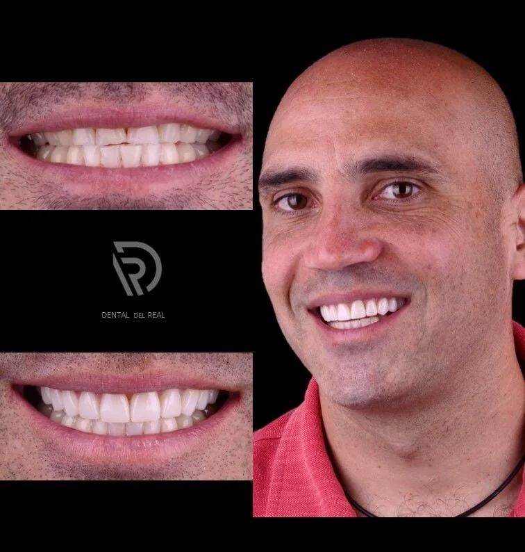 Before and after smile design - Dental del Real