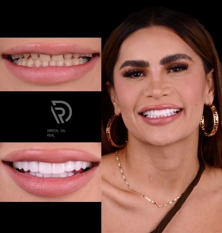 Full smile makeover in Guadalajara