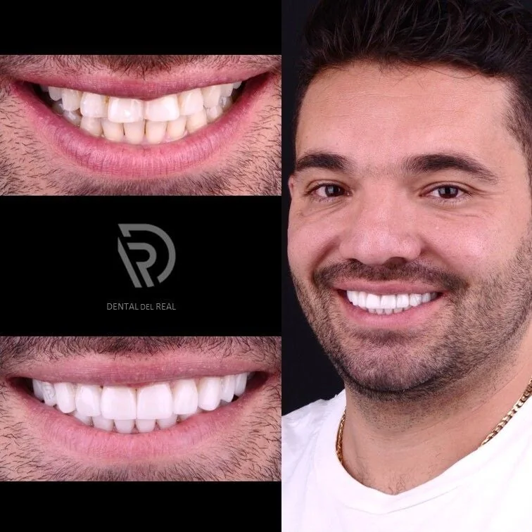 Porcelain veneers result - Dental del Real