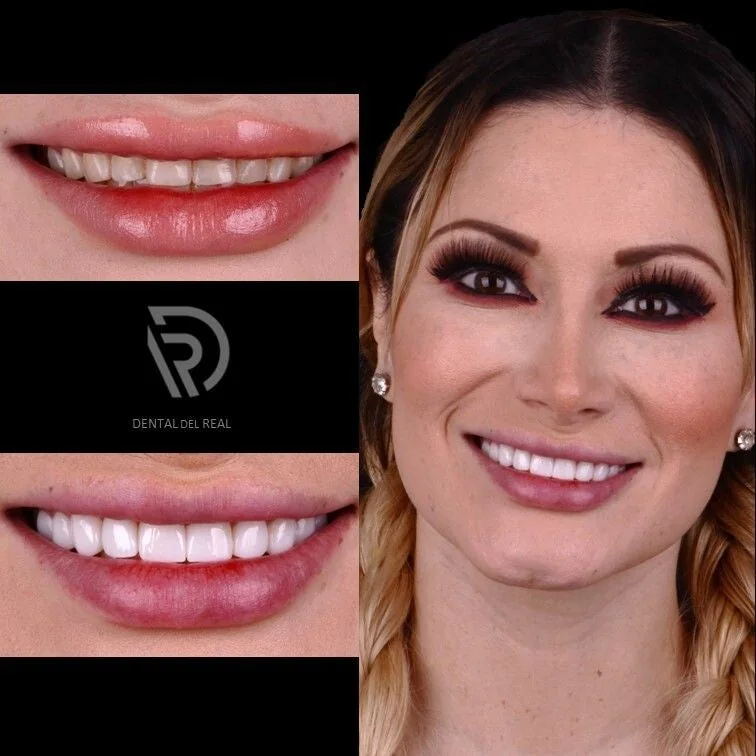 Smile design before and after - Zapopan