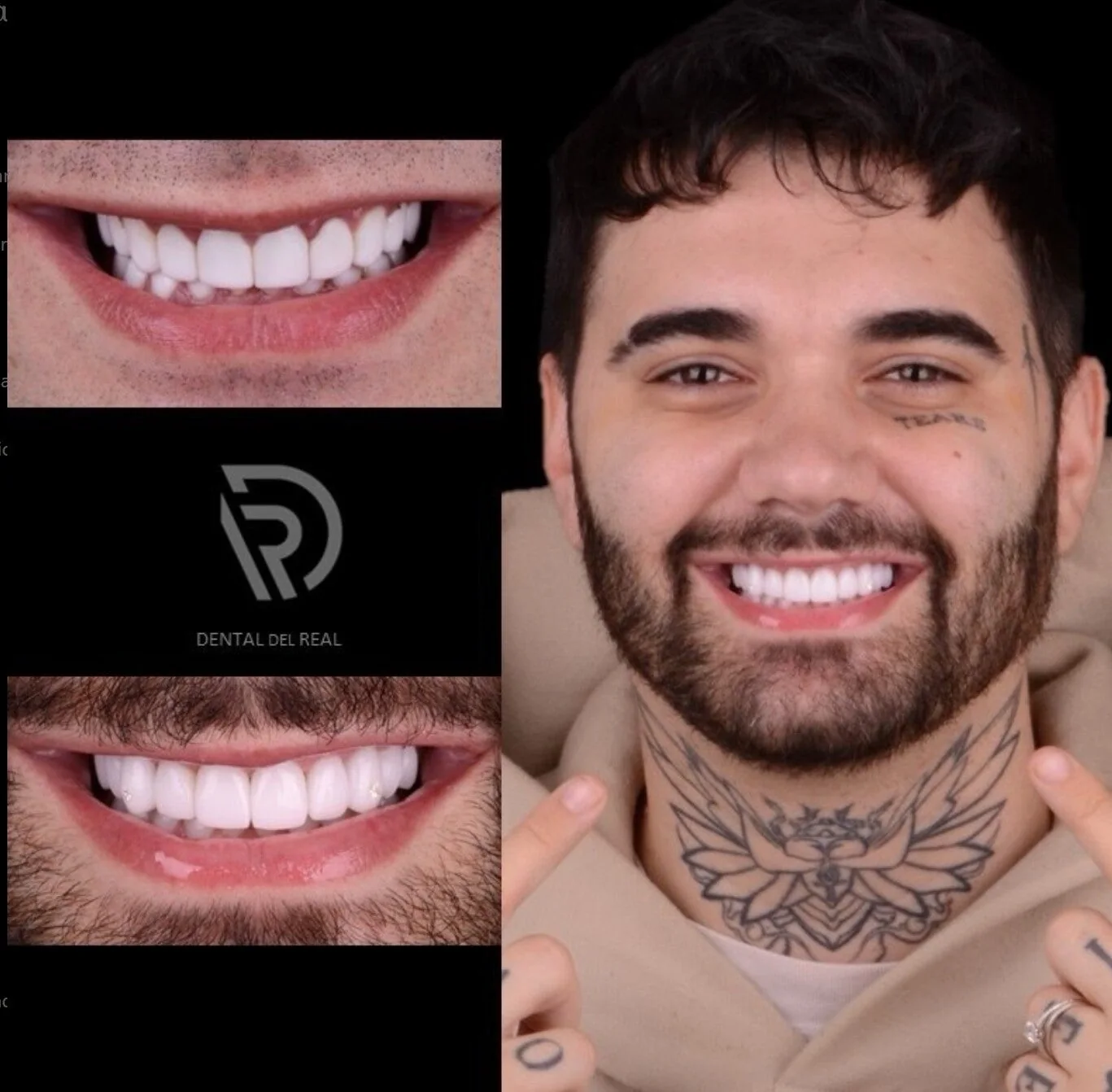 Smile transformation with veneers - Dental del Real
