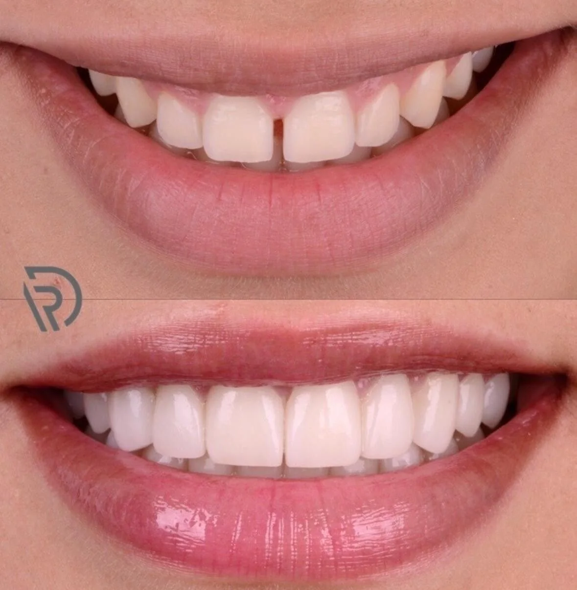Veneers before and after close-up