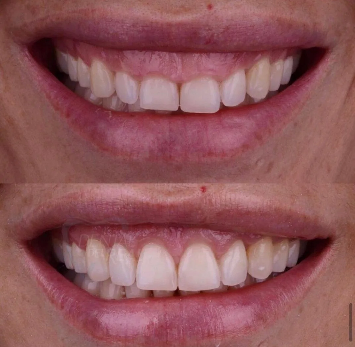 Natural veneers result - Dental del Real