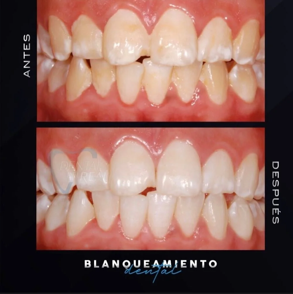 Teeth whitening before and after - Dental del Real