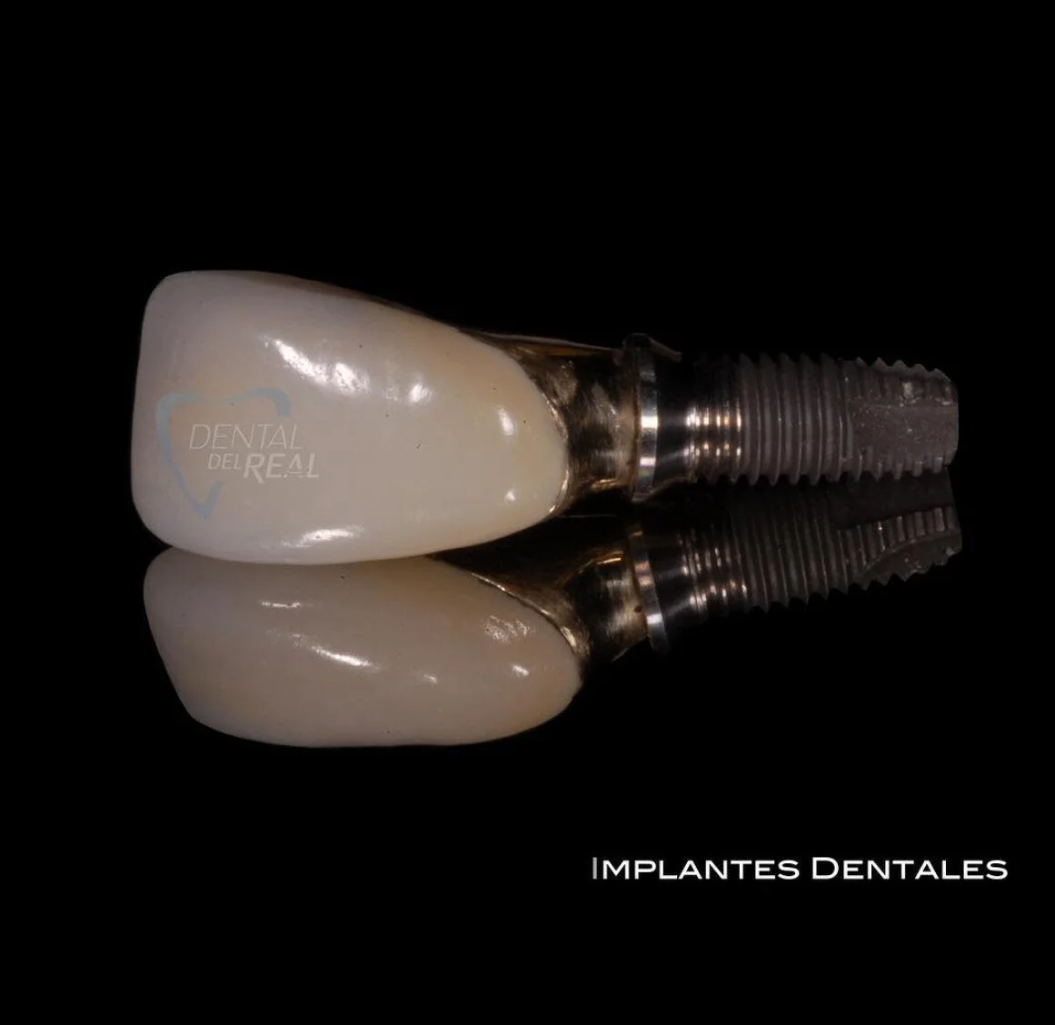 Dental implant crown - Dental del Real
