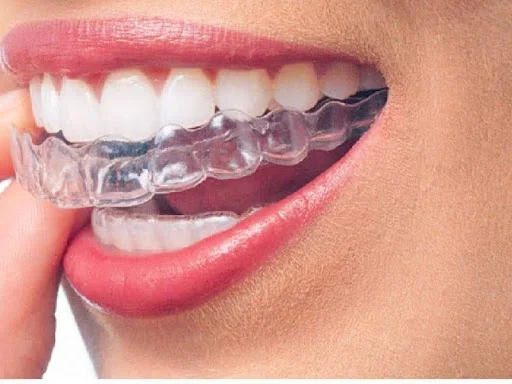 Clear aligners and orthodontics