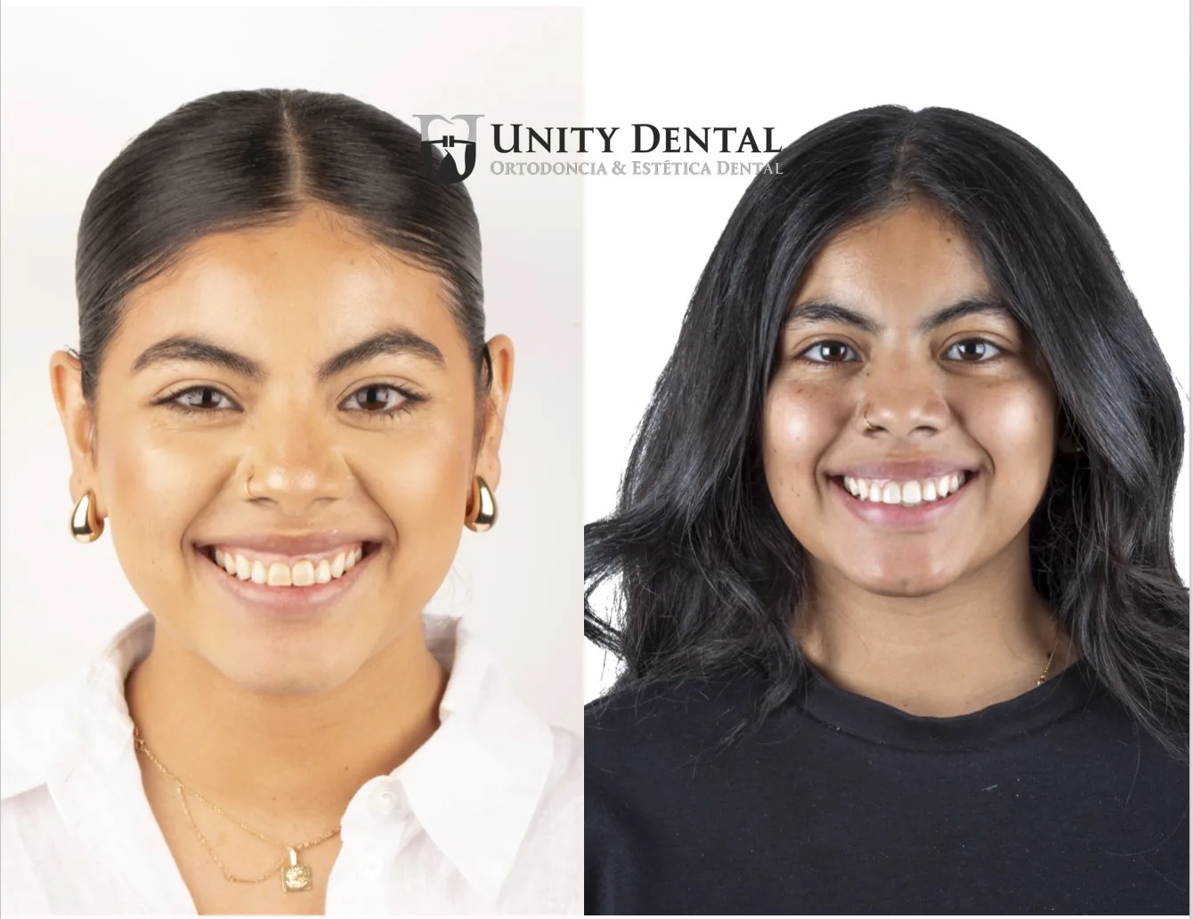 Orthodontic smile transformation at Unity Dental Mexicali