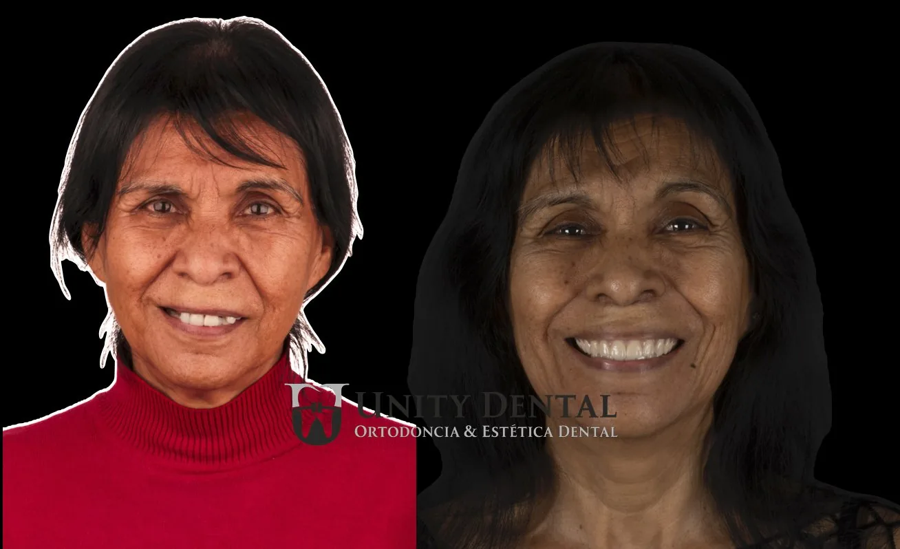 Smile rehabilitation before and after - All-on-6 case at Unity Dental