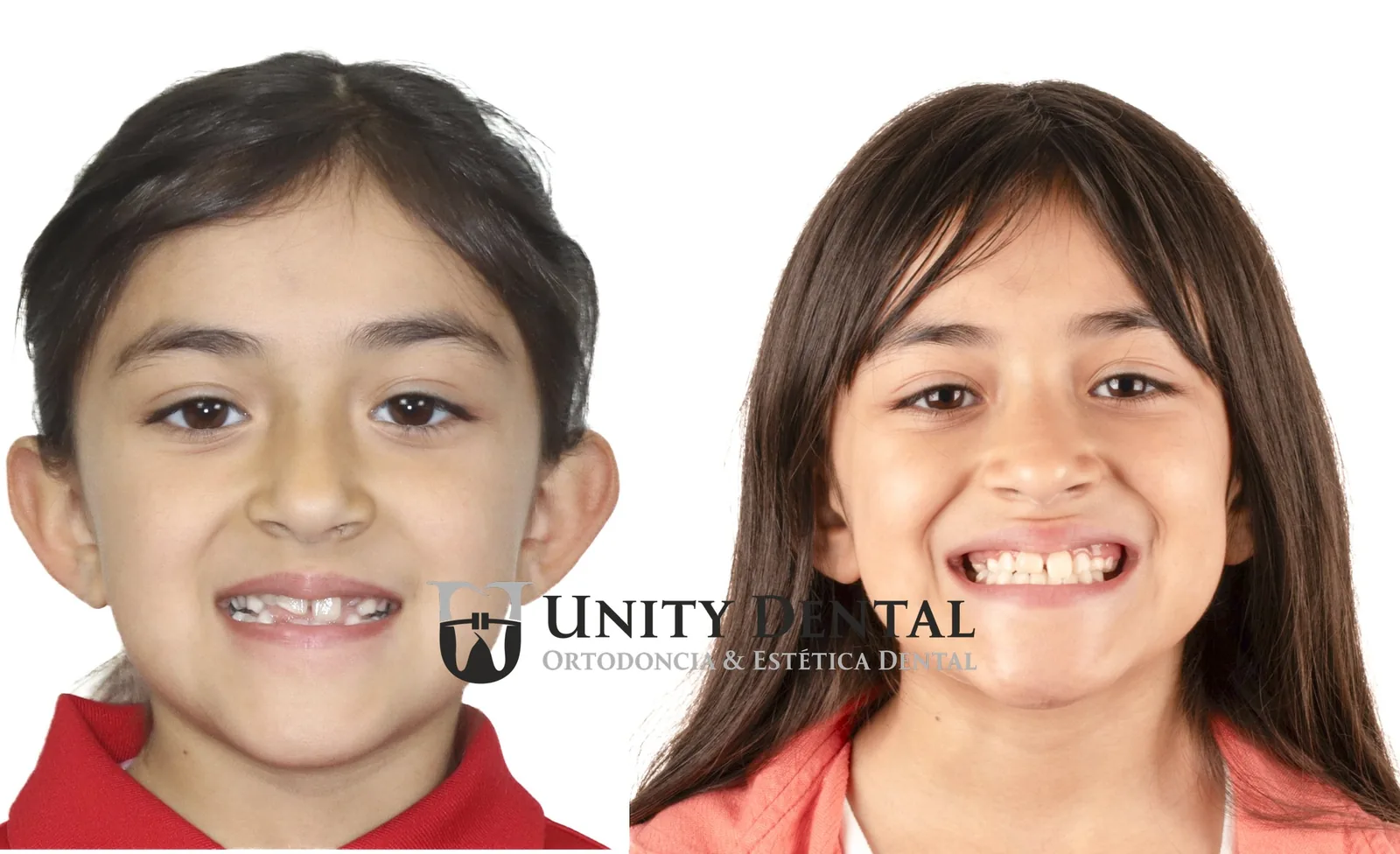 Child orthopedic treatment with expander - before and after