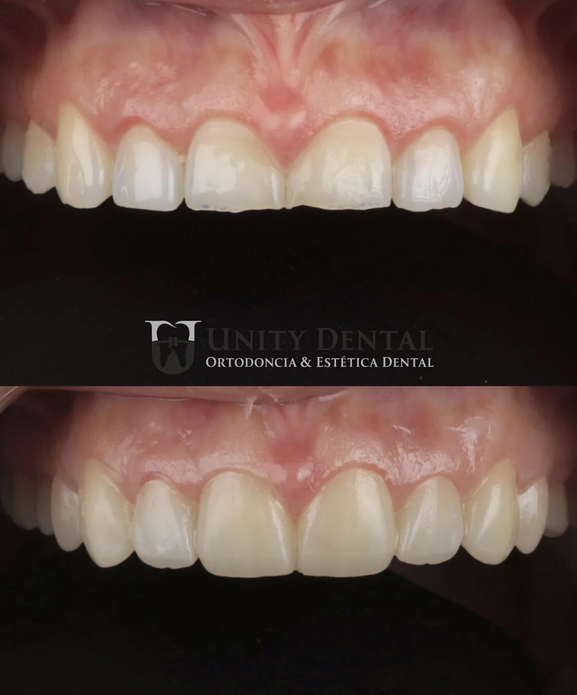 Dental veneers before and after - Unity Dental Mexicali