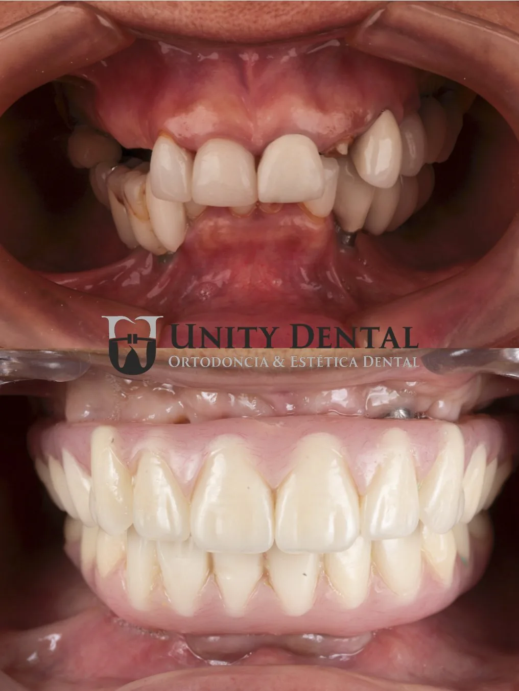 Full-arch rehabilitation before and after - Unity Dental