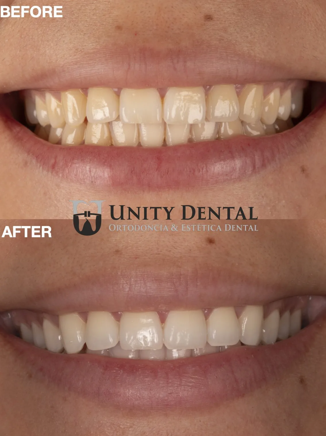 Teeth whitening before and after - Unity Dental Mexicali