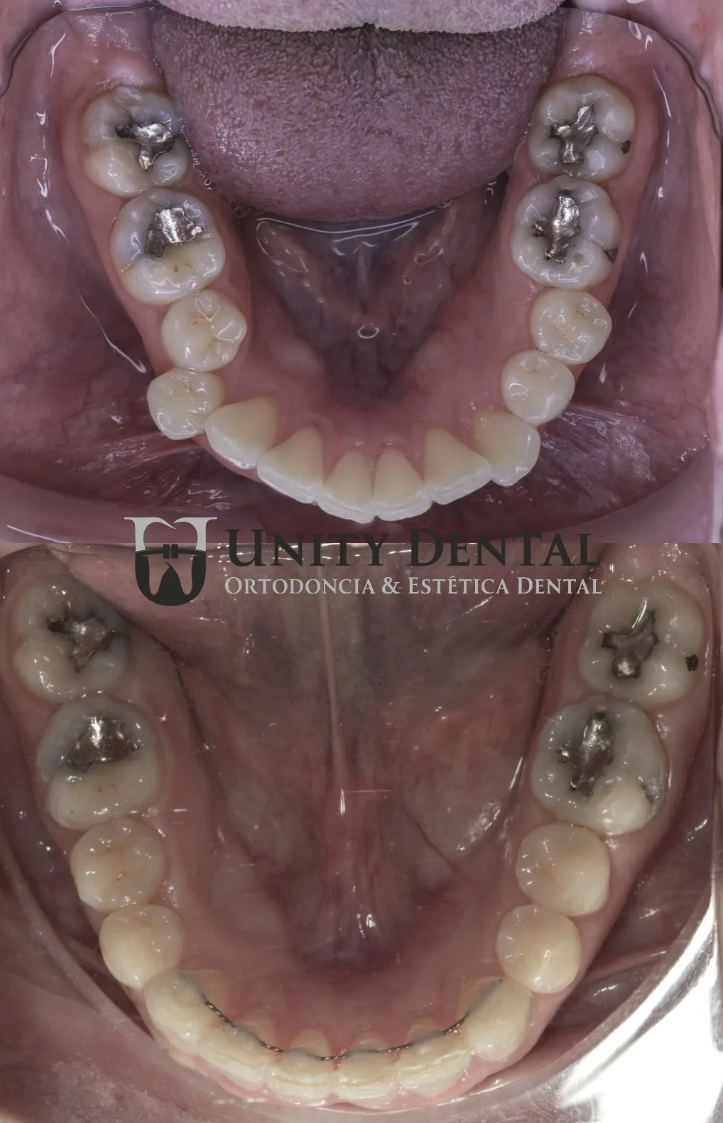 Clear aligners and fixed retainer result - Unity Dental