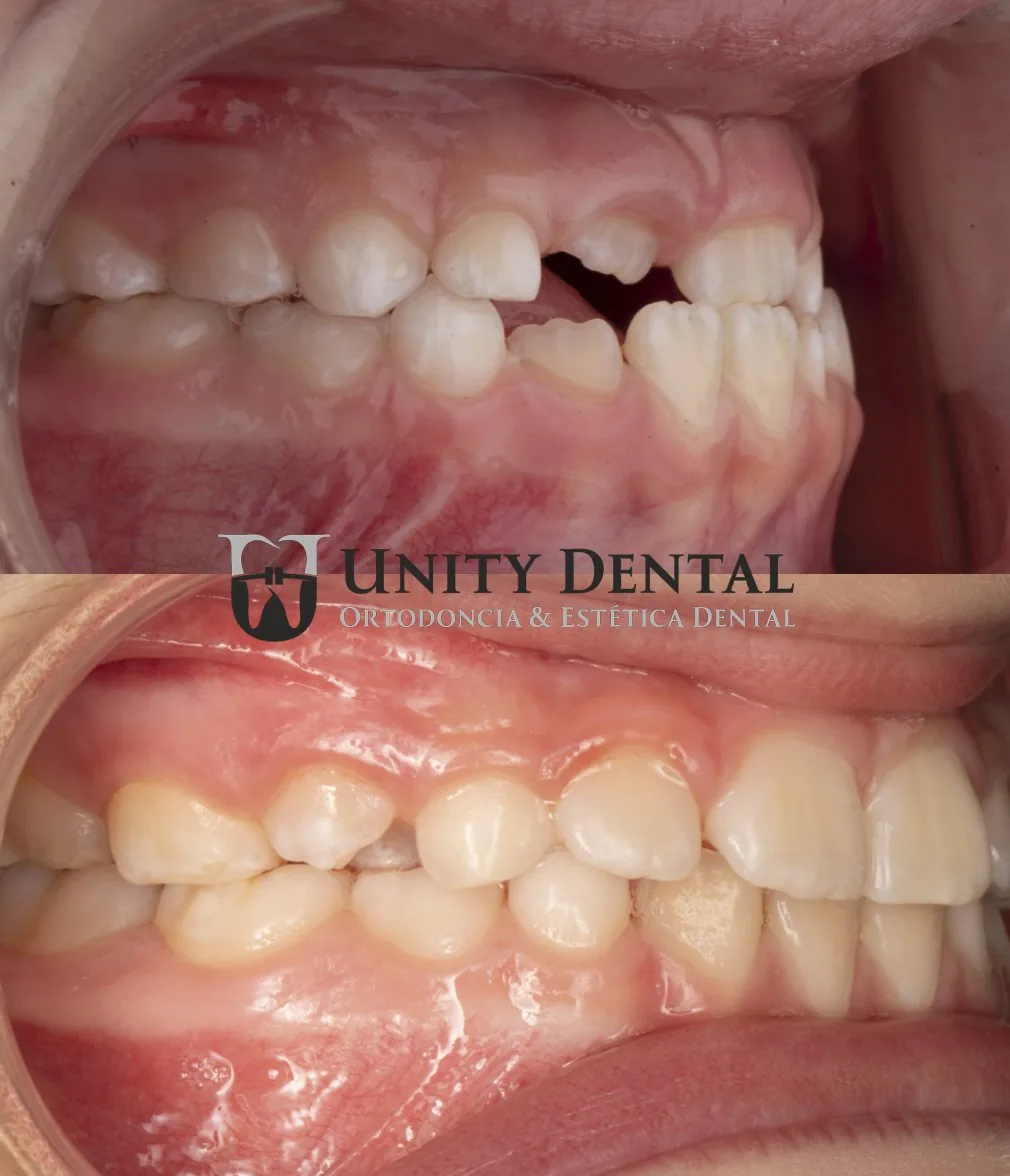 Dental alignment before and after orthodontics