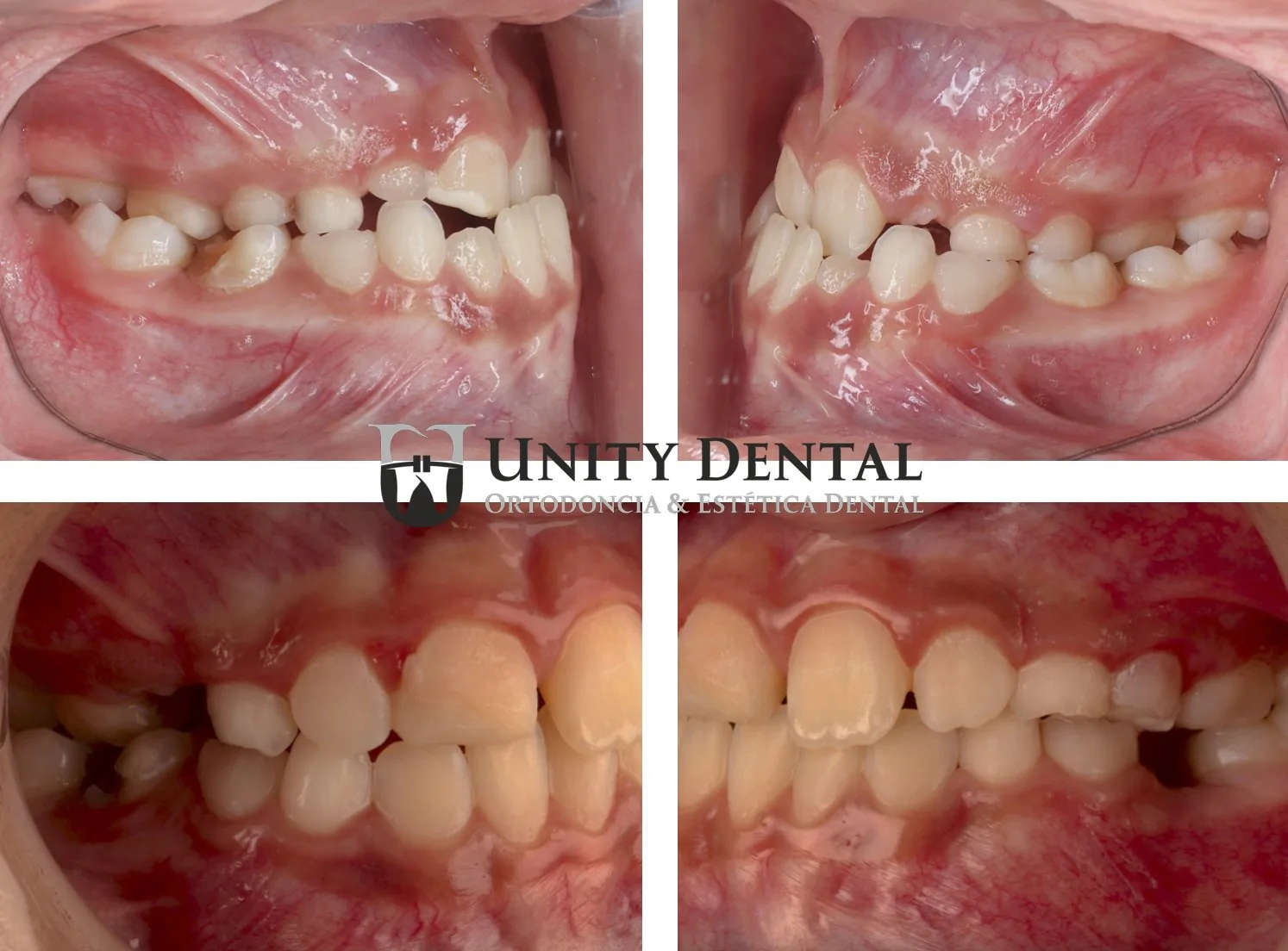Orthodontic treatment for a young patient - before and after