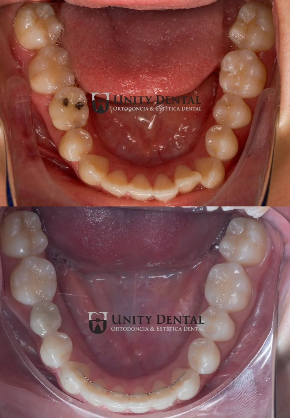 Lower teeth before and after self-ligating braces