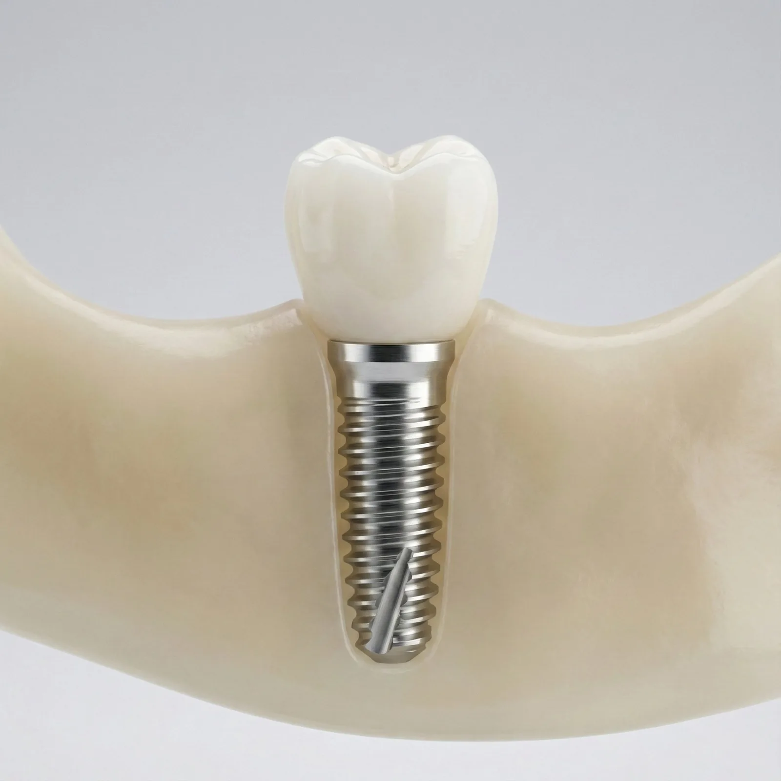 Dental implant model - Unity Dental