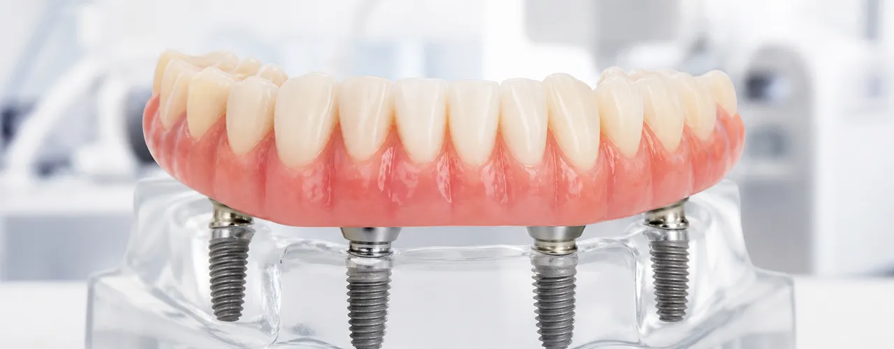 All-on-4 Dental Implants in Mexico City: Cost, Process & Results (2026 Guide)