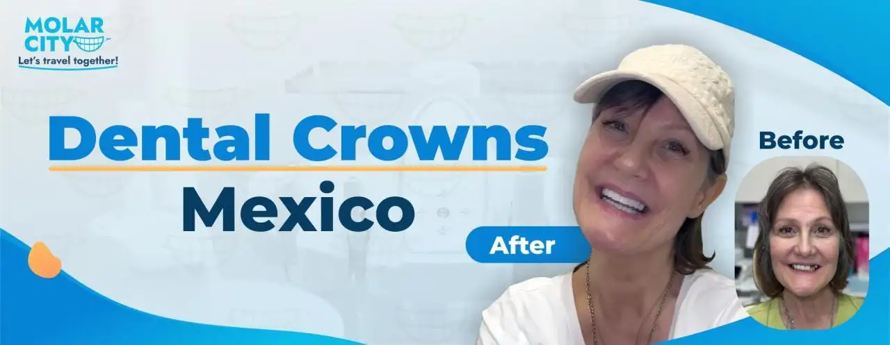 Dental Crowns Mexico