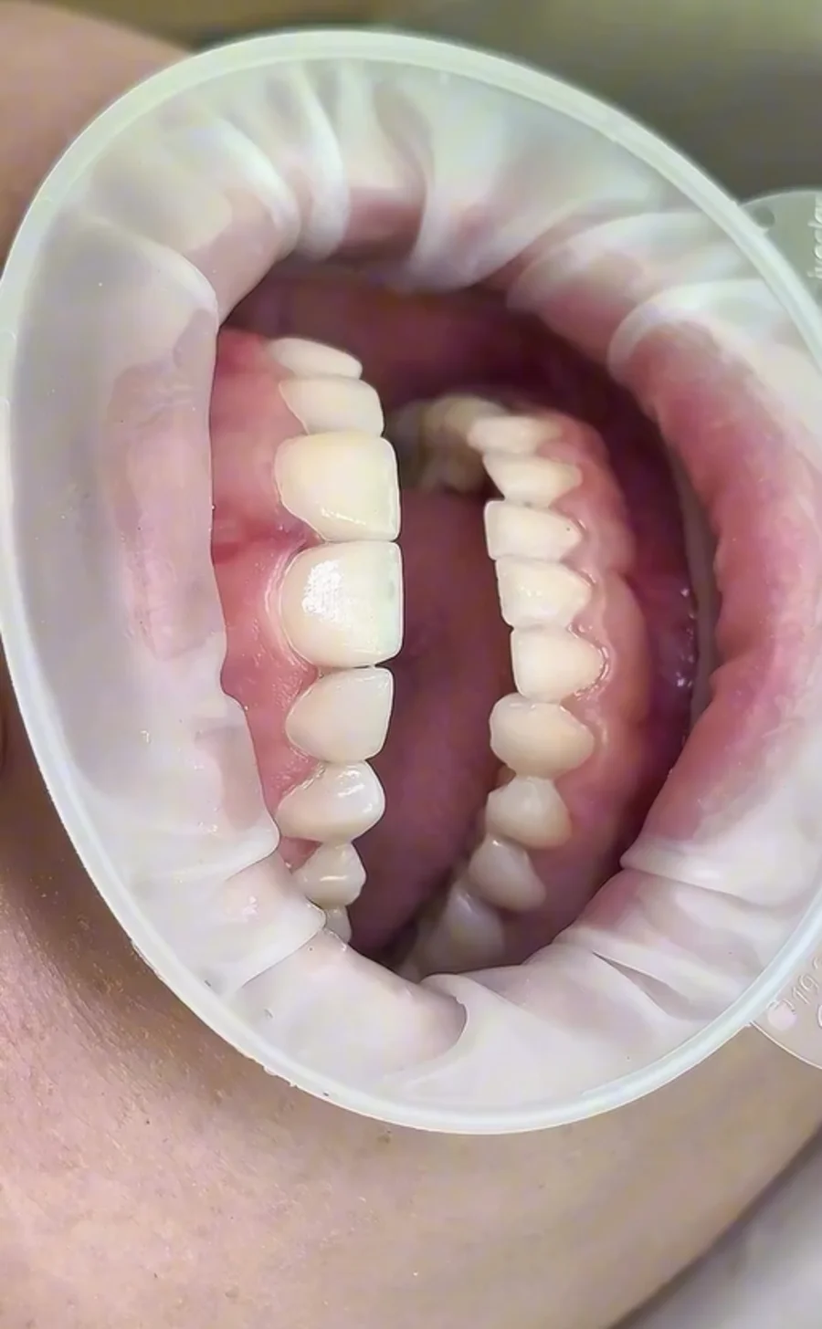 Dental result