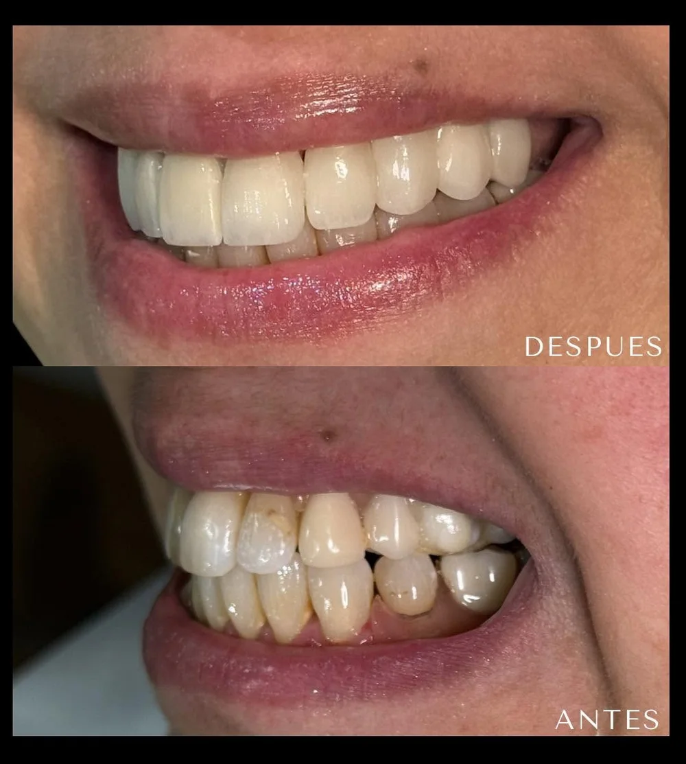 Smile design — before & after
