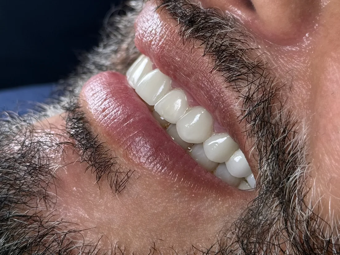 Smile makeover