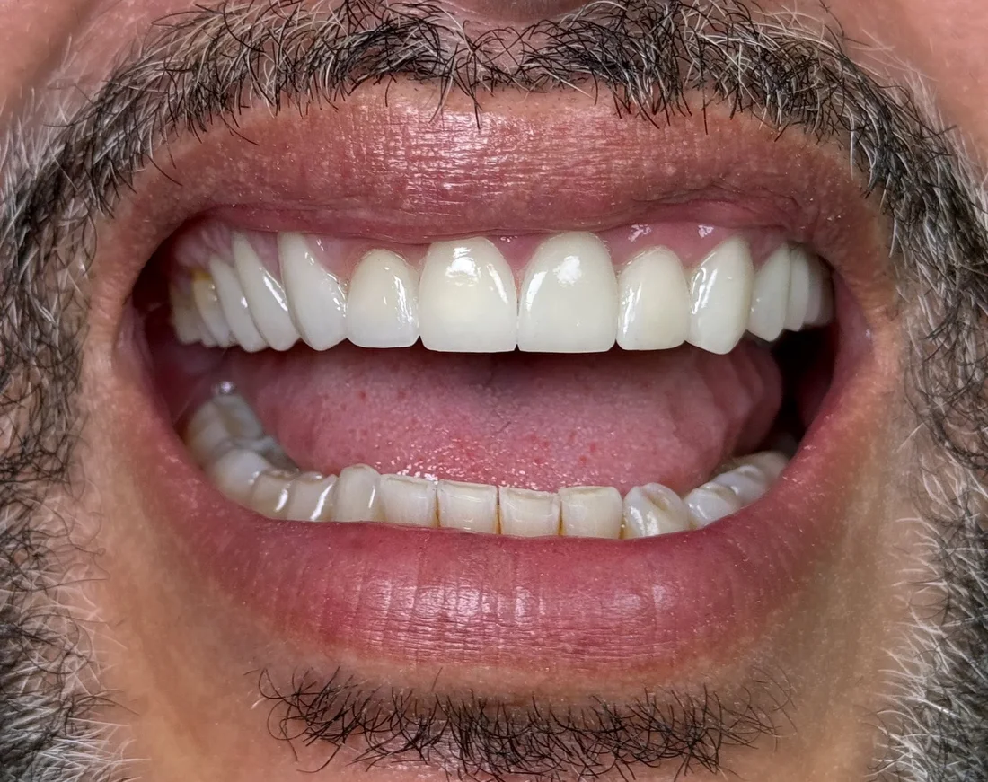 Porcelain veneers