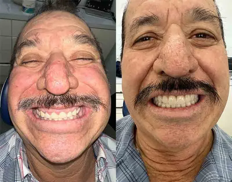 Before & after — All-on-4 full-arch with zirconia crowns