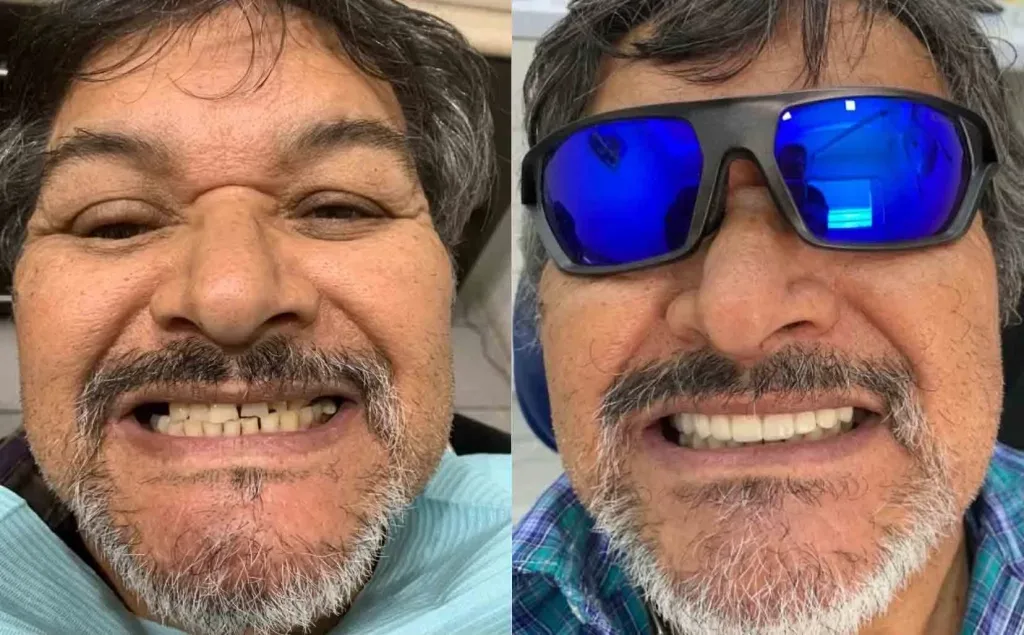 Before & after — Dental implant with zirconia crown