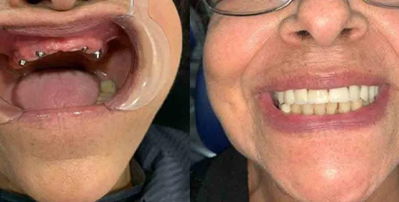 Before & after — All-on-4 dental implants