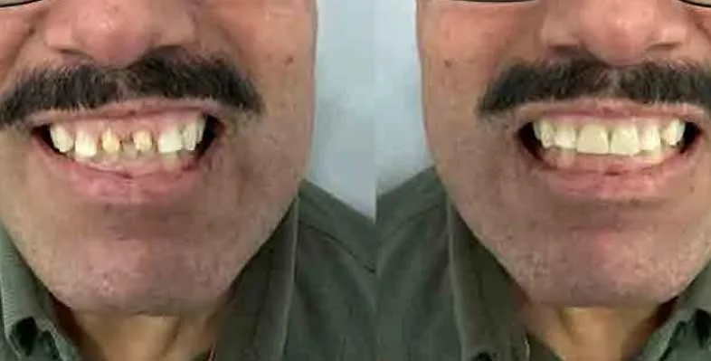 Before & after — Porcelain E.max crowns